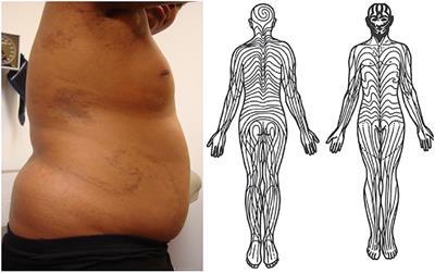 Immunopathogenesis of Pediatric Localized Scleroderma